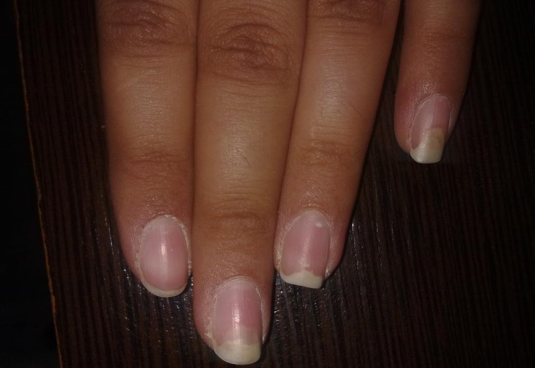 Onycholysis, nail coming away from skin. <br>Image credit: Alborz Fallah, (2013, August 3)</br>