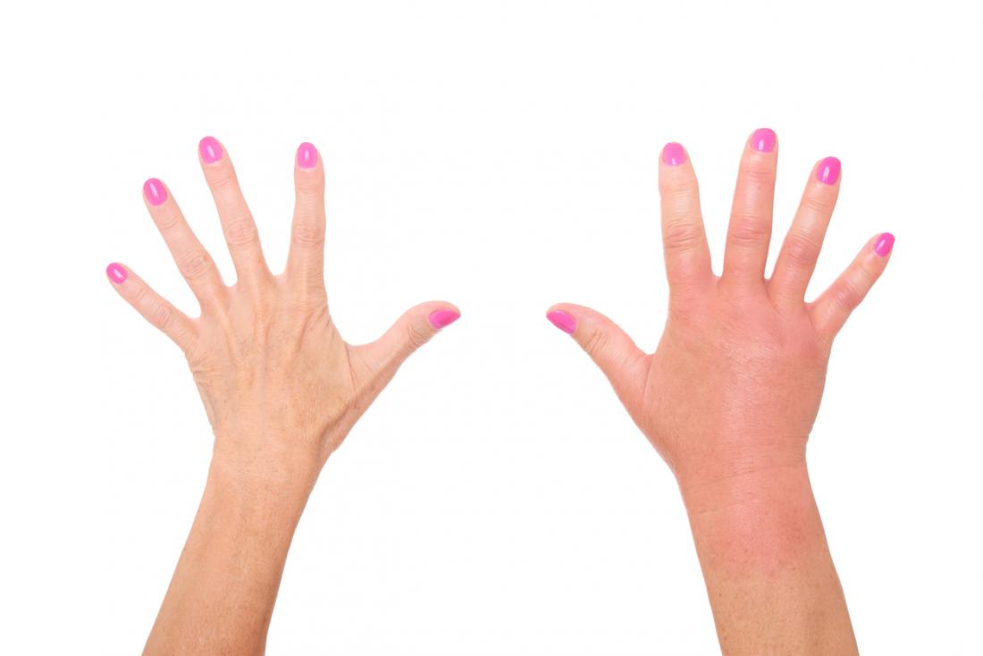 Causas dactilitis (dedos de salchicha)