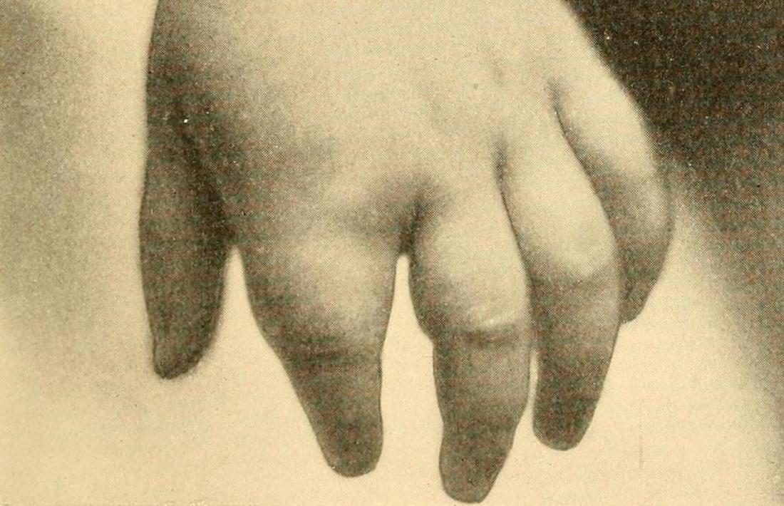 Dactylitis <br>Image credit: Internet Archive Book Images, (2015, September 17)</br>