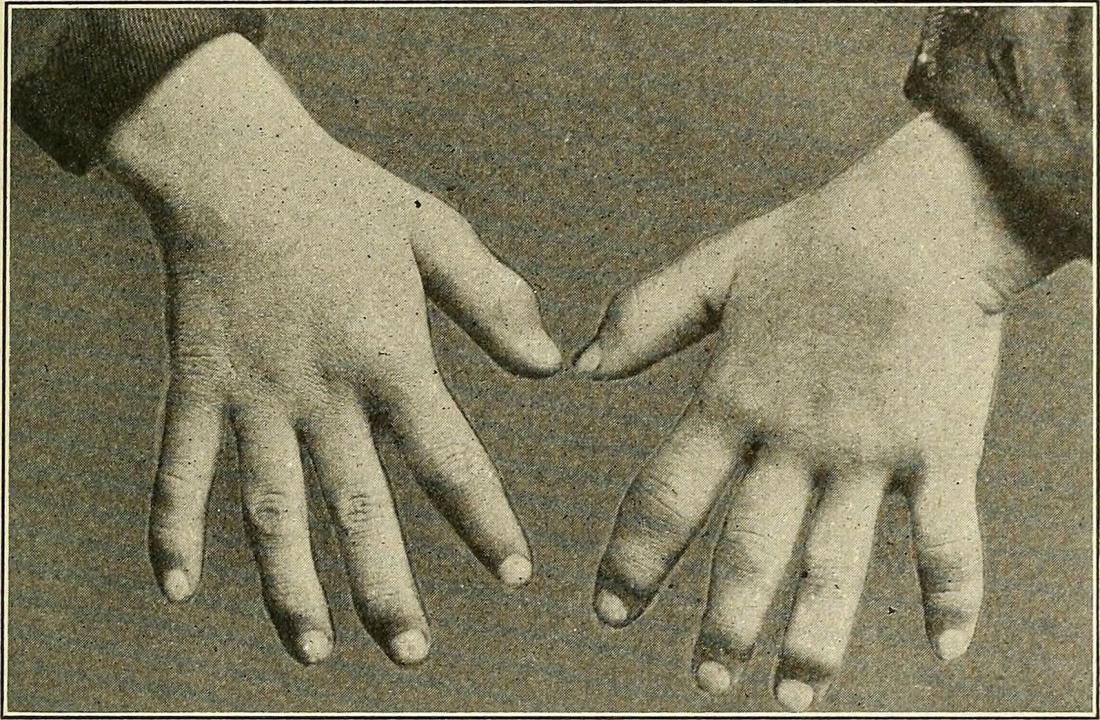 Syphilitic dactylitis <br>Image credit: Internet Archive Book Images, (2015, September 17)</br>