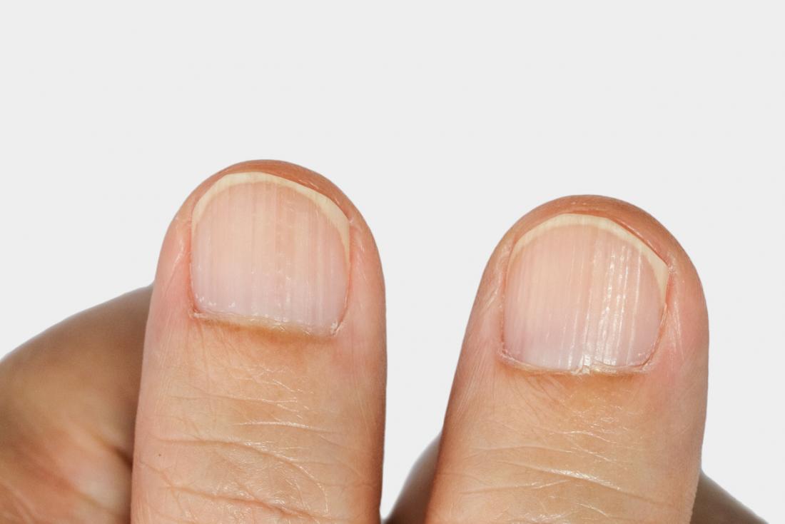 Ridges On The Fingernails 