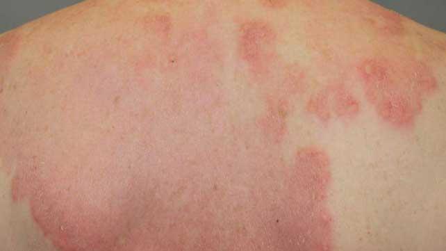 autoimmune disease skin rash