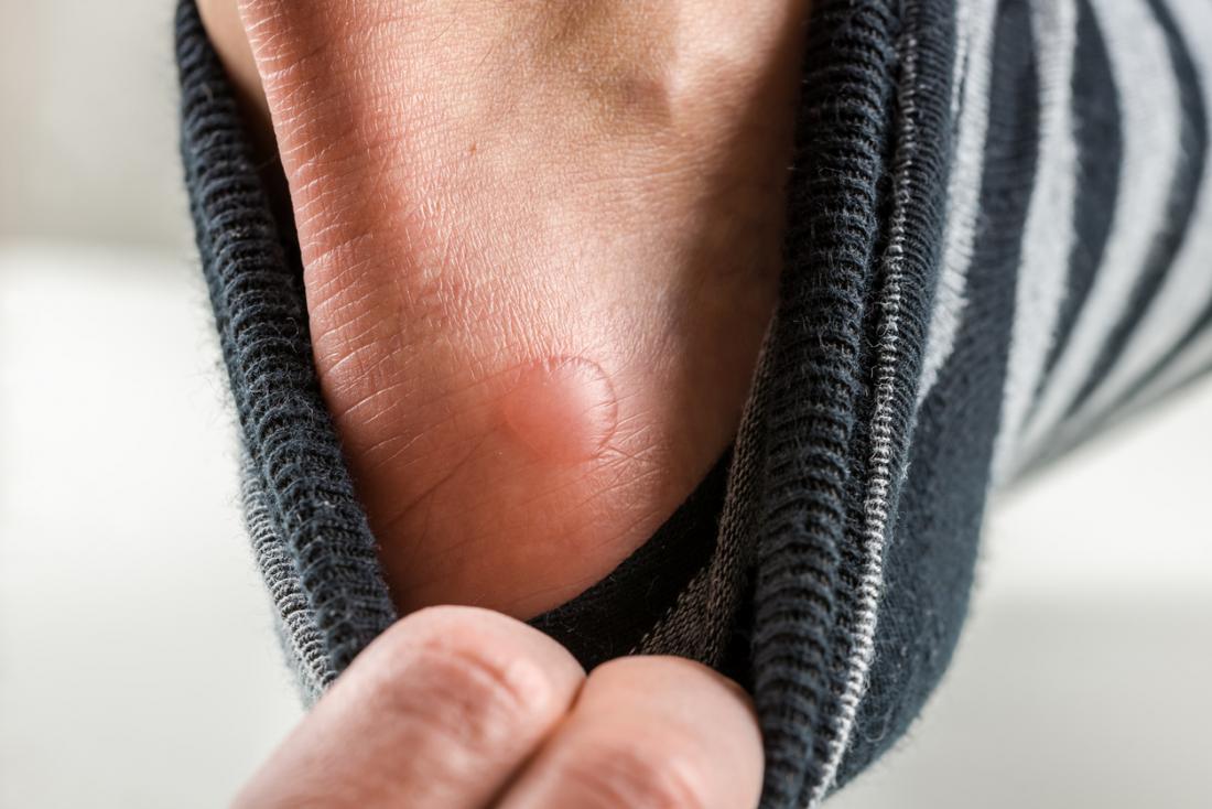 Blisters on the feet: Causes, treatment 