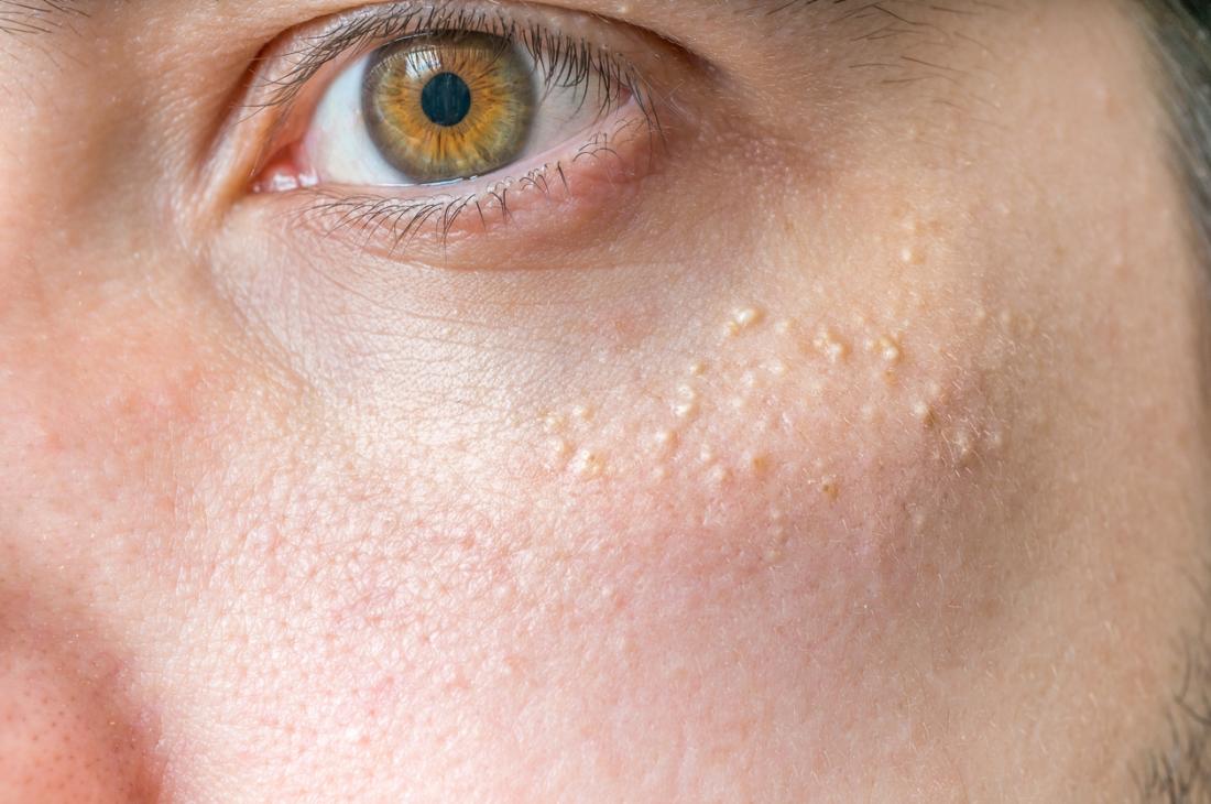 White Spots On the Skin: Possible Causes and Treatments