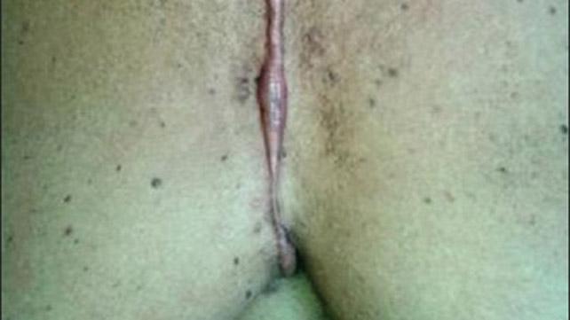 Dermatitis neglecta. Image credits: Indian Journal of Dermatology