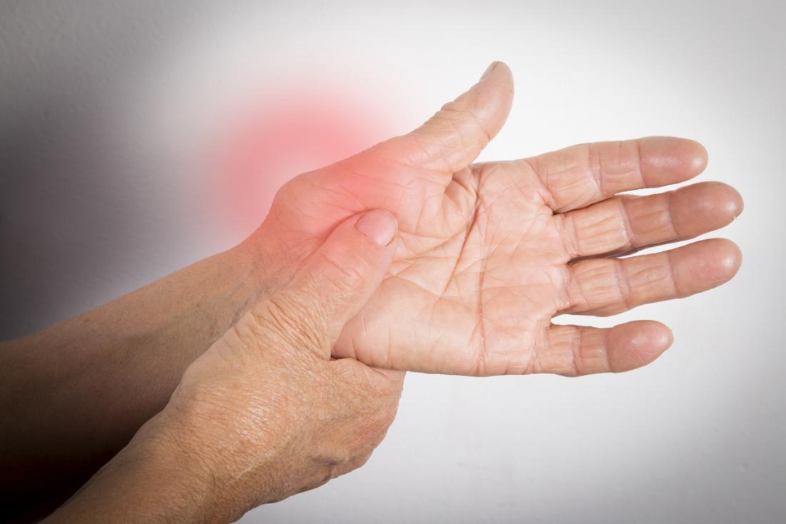 Left Palm Up   Rheumatoid Arthritis In The Left Hand 