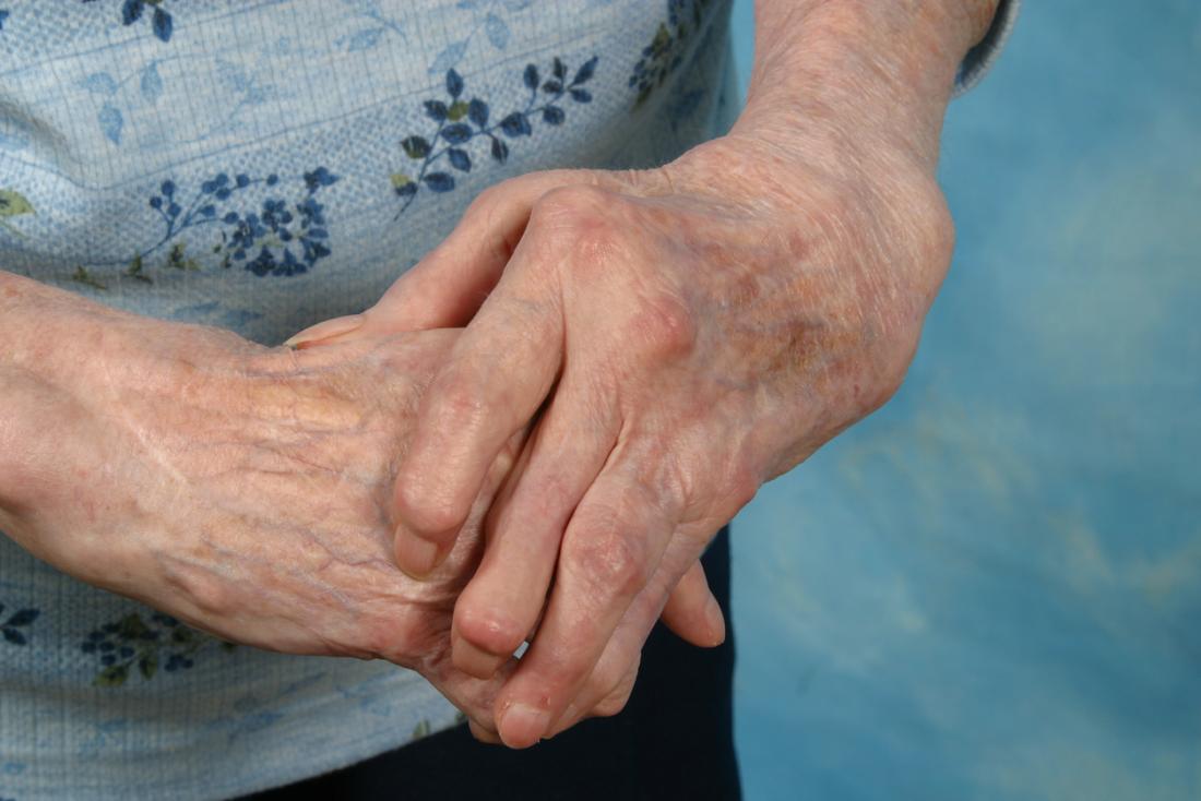 Fuera de canta Pólvora Artritis en las manos: Síntomas, tratamiento y remedios caseros