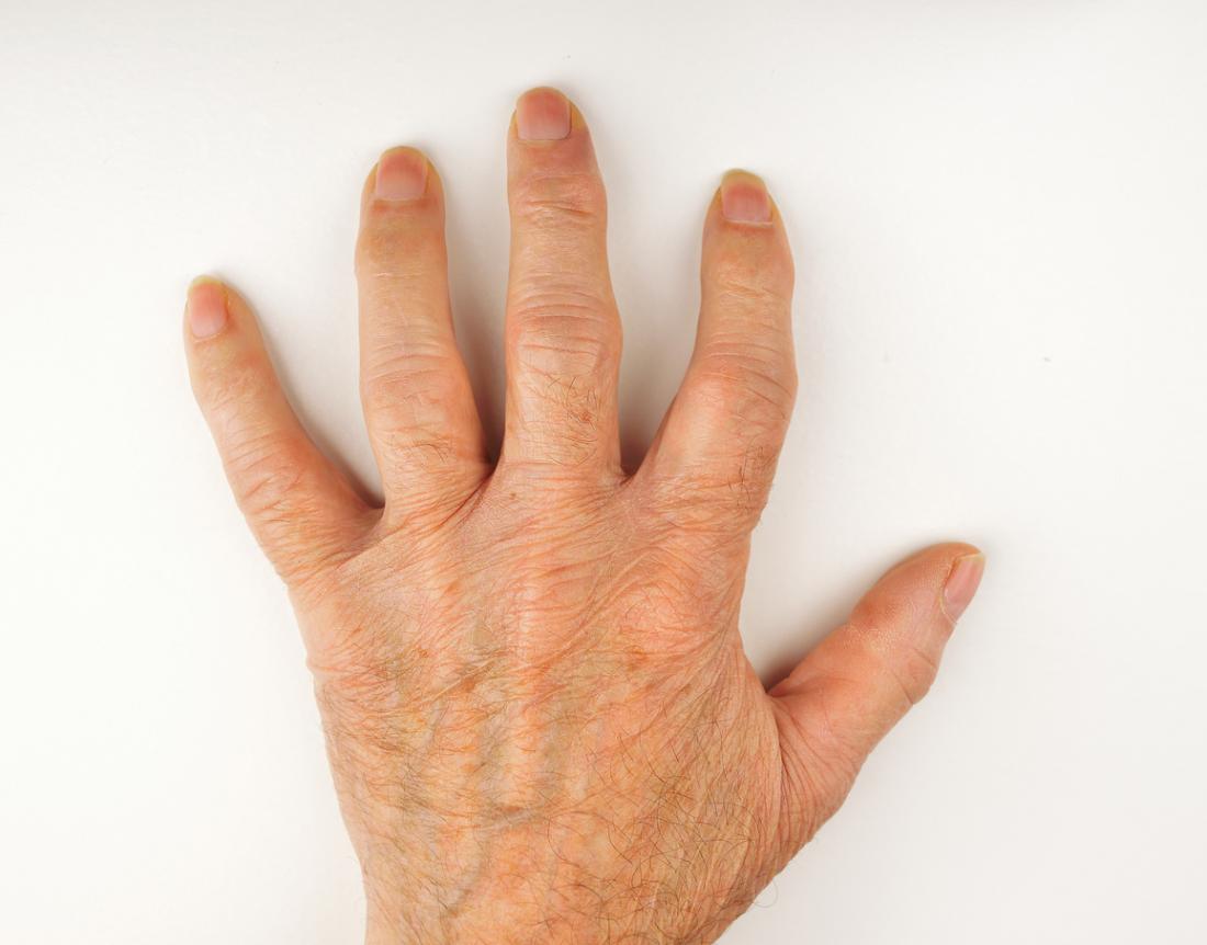 can arthritis start in one finger