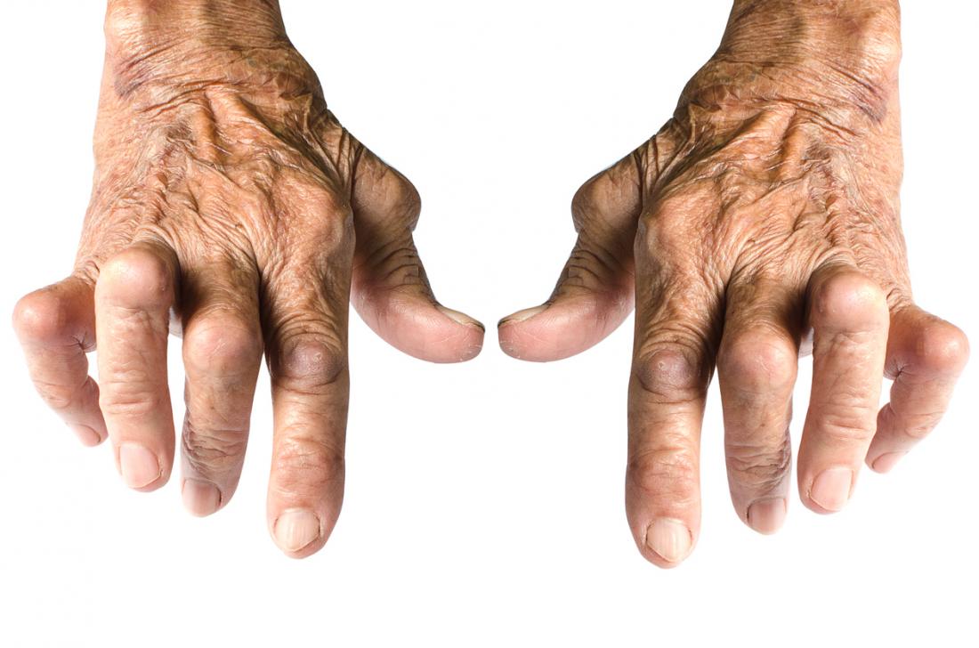 Arthritis in hands Symptoms, treatment, and home remedies