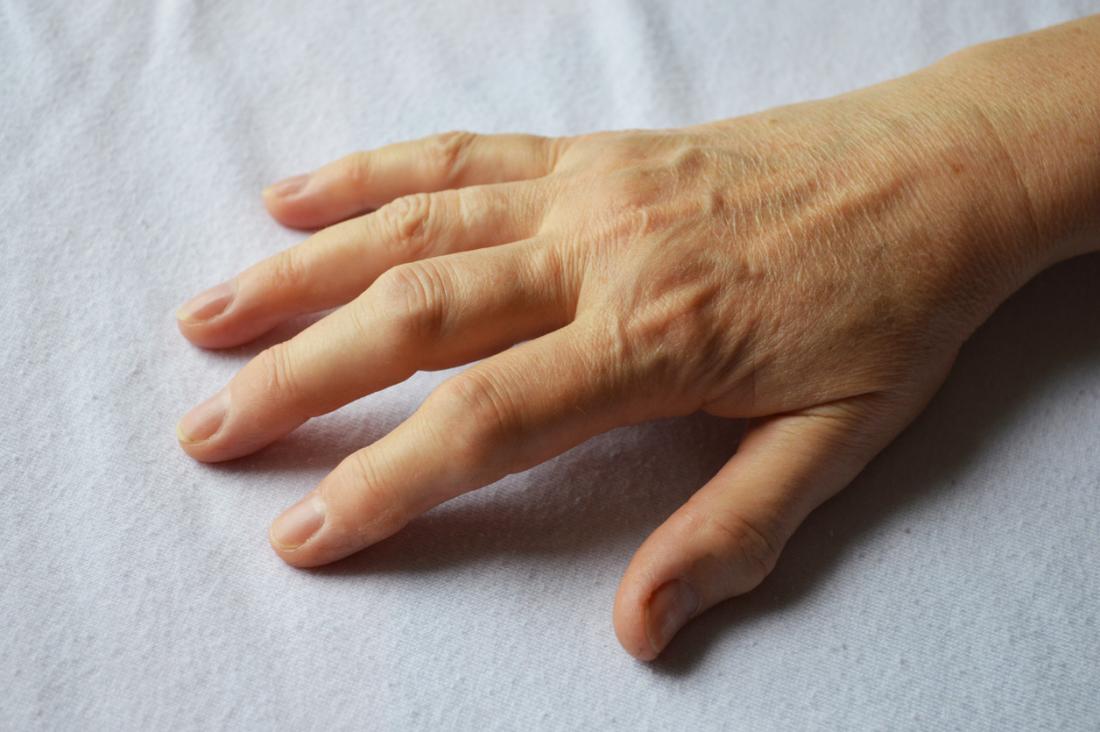 Arthritis in hands Symptoms, treatment, and home remedies