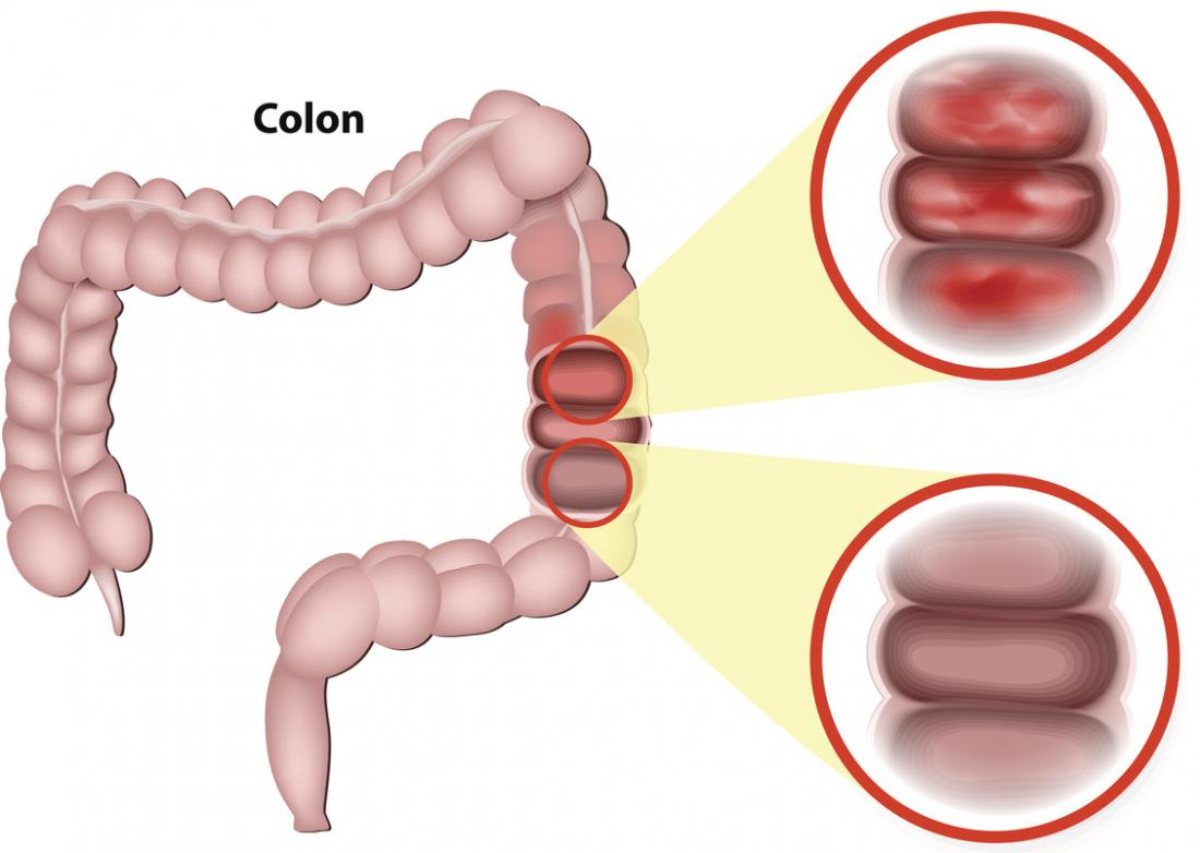 left-sided-colitis-symptoms-diagnosis-and-treatment