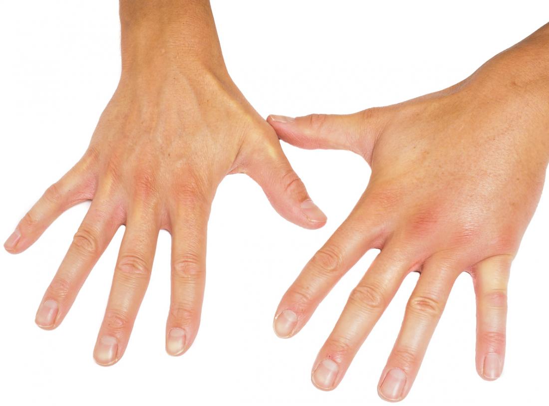 Swollen hand