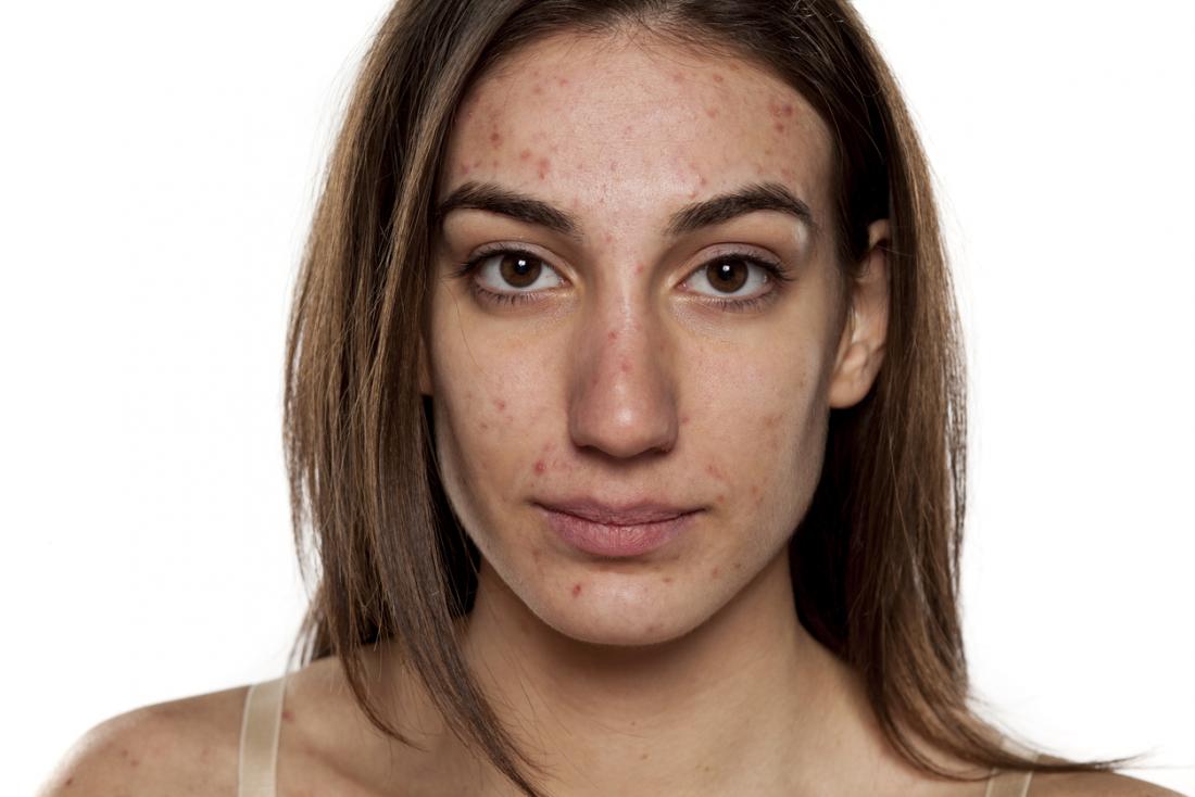 How to get clear skin: Fast, naturally, and at home