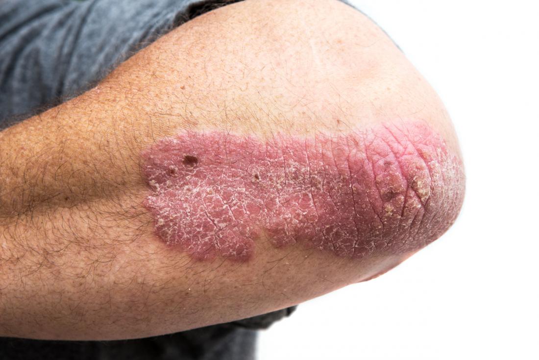 Psoriasis on elbow.