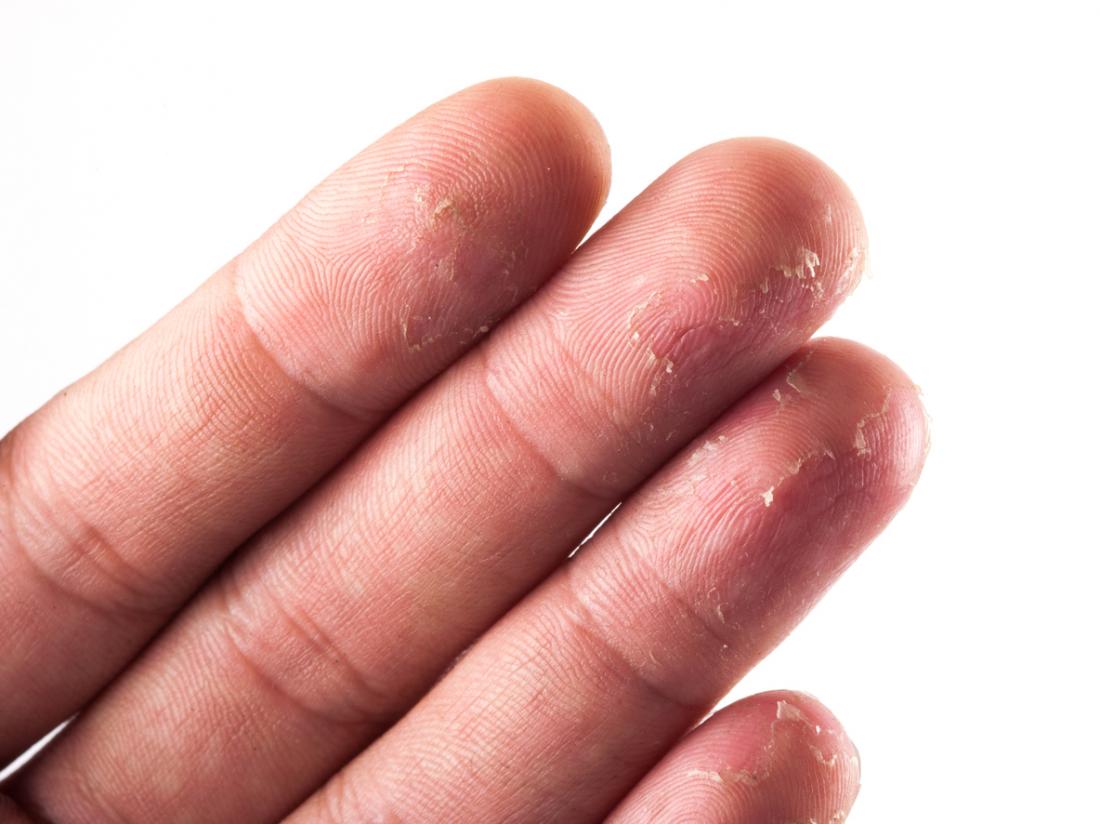 Sore Hard Skin On Fingertips