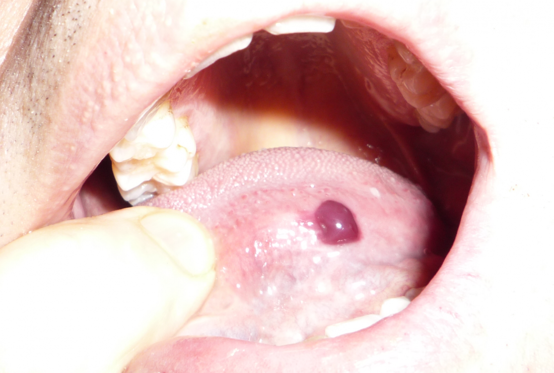 blood blister in mouth caused by angina bullosa haemorrhage image credit angus johnson 2013 may 1