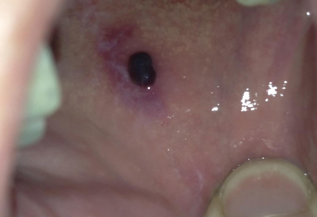 Blood Blister In Mouth Causes And Remedies