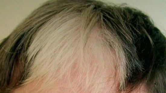 Poliosis: Causes, symptoms, and treatment