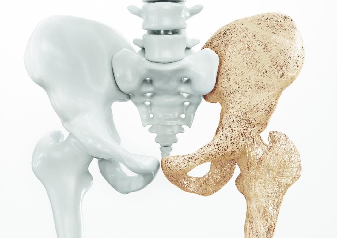 osteoporosis in hip