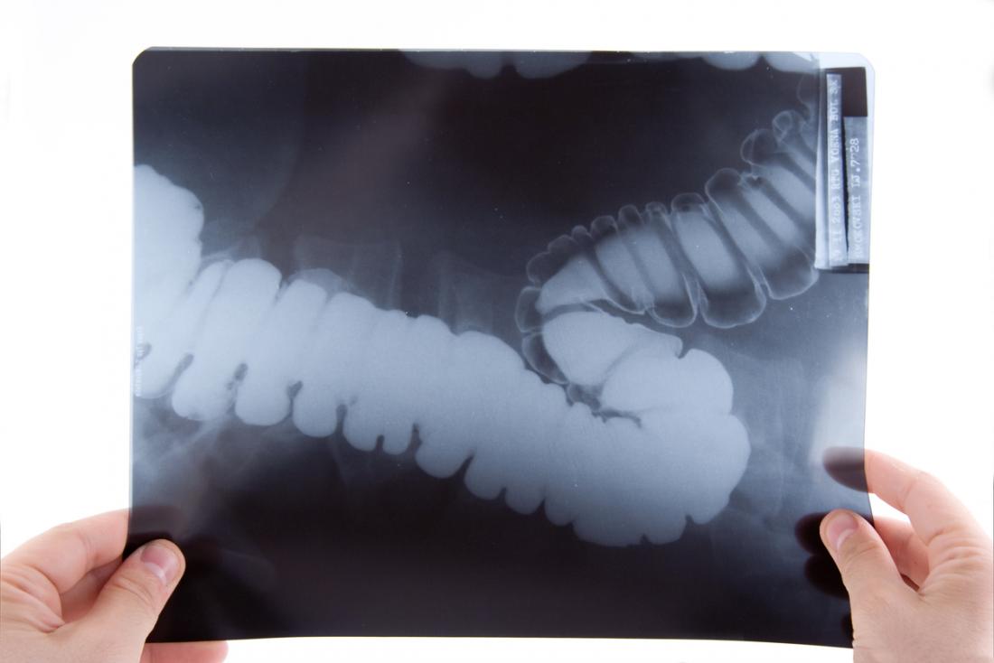 X-ray of colon.