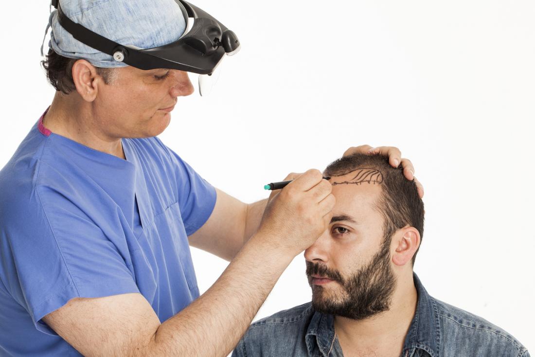 Hair transplant: Costs, recovery, and what to expect