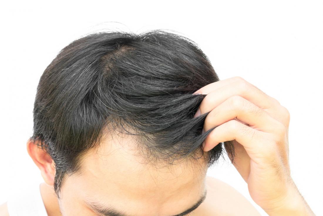 Why is my hair falling out? Nature and nurture triggers of male hair l