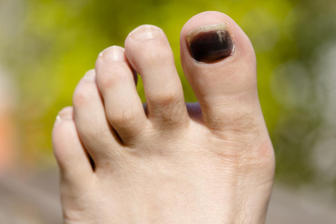 When To See A Physician After Painful Toenail Injury