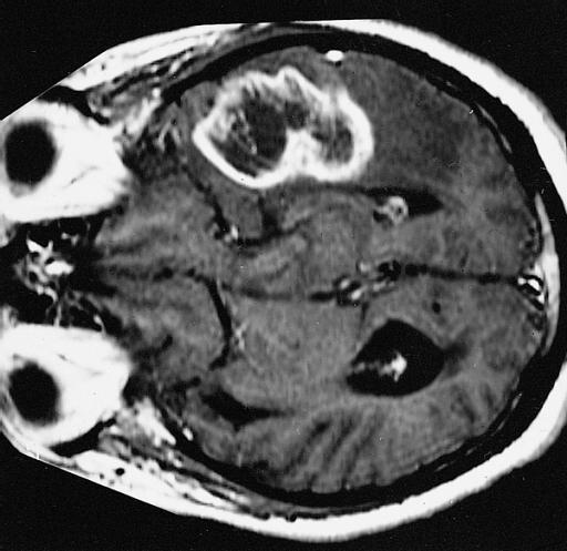 glioblastoma multiforme, shown in MRI of person with tumefactive MS. Image credit: The Armed Forces Institute of Pathology, (2008, July 2).