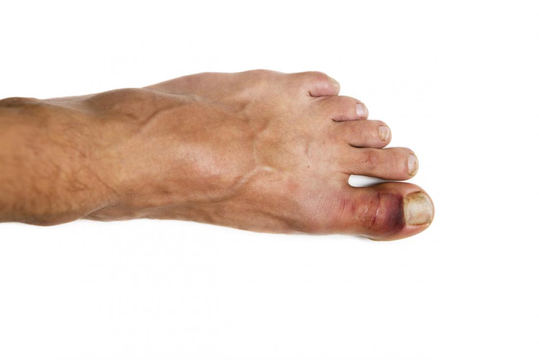 Broken toe: Symptoms, pictures, and treatment