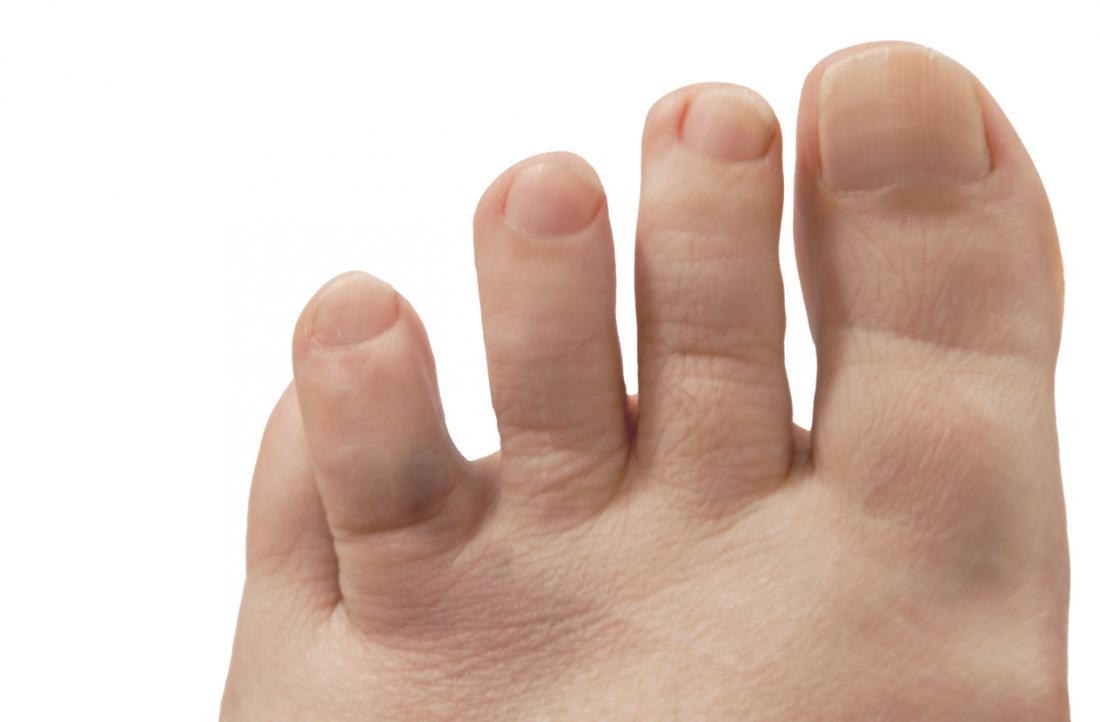 Broken Toe: Causes, Symptoms, and Treatment - wide 4