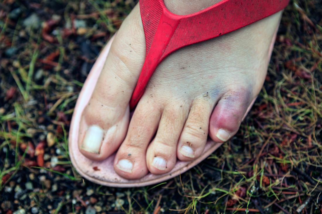 Broken Toe Symptoms Pictures And Treatment