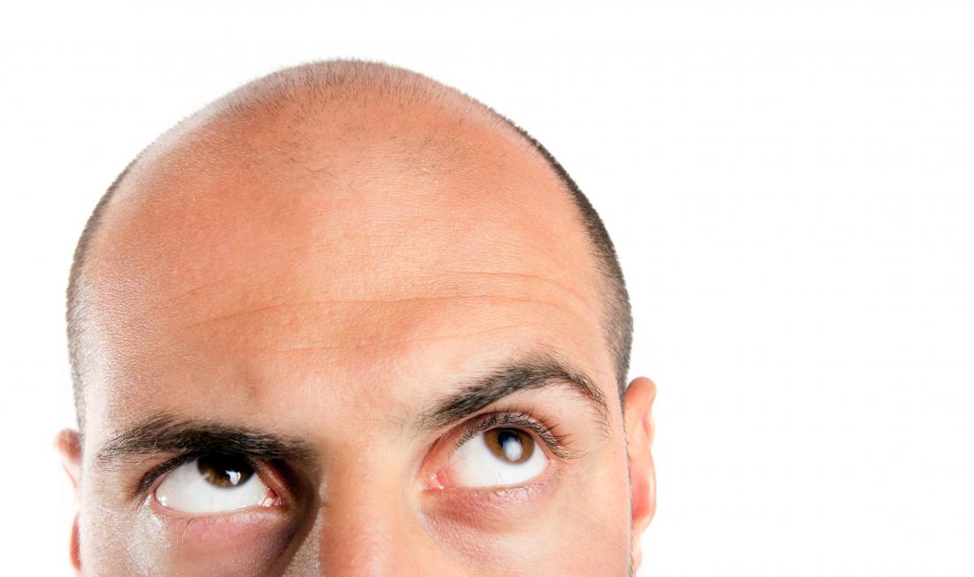 Heart disease risk increased fivefold for bald and graying men