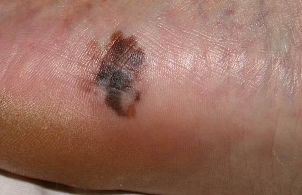 Lentiginous melanoma acral Pathology Outlines