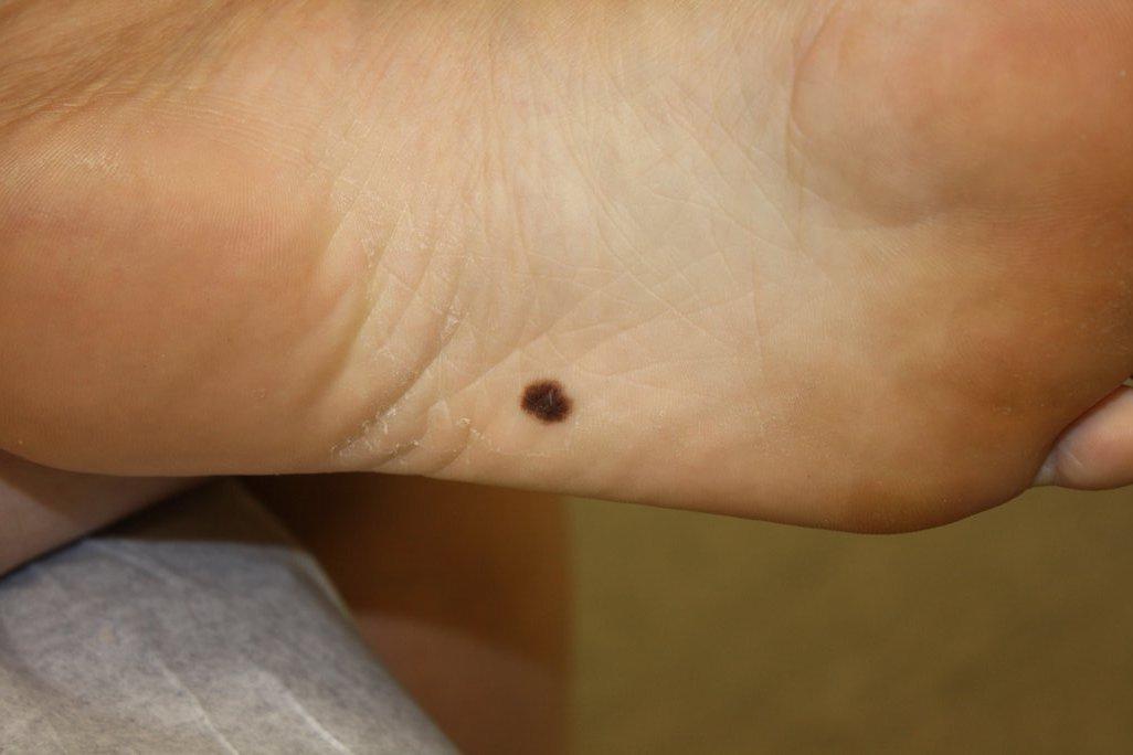 Dark Spot On Bottom Of Foot Bump On The Bottom Of The Foot CTXD