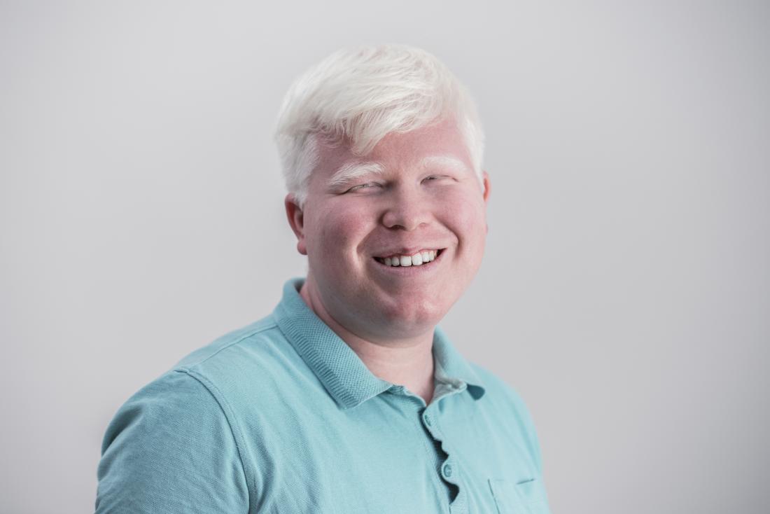 Asian man with albinism.