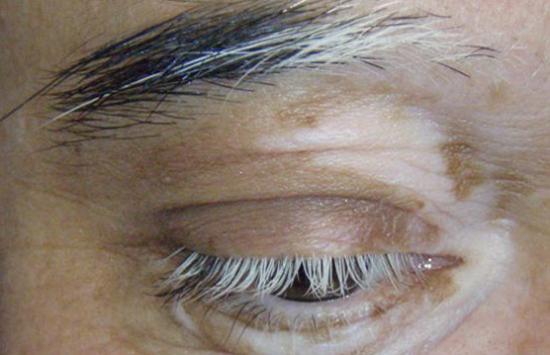 Vitiligo around the eye, with poliosis causing white eyelashes and eyebrows.