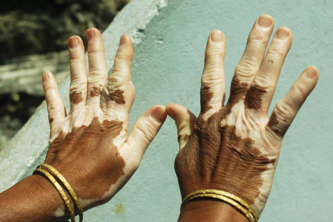 Vitiligo on hands.