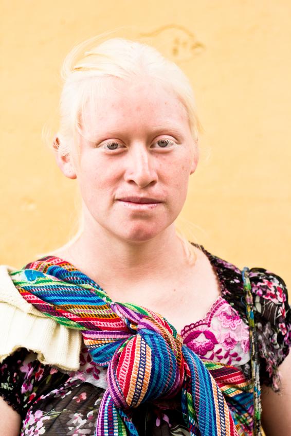 Woman with albinism.