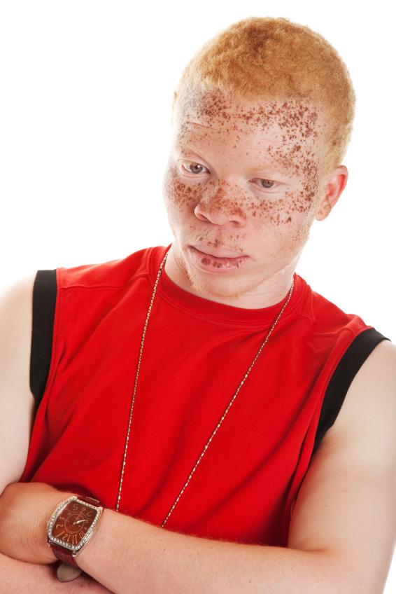 Young man with albinism.
