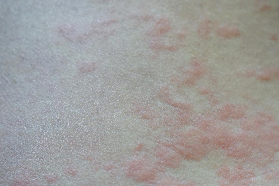 How to treat itchy allergic reaction