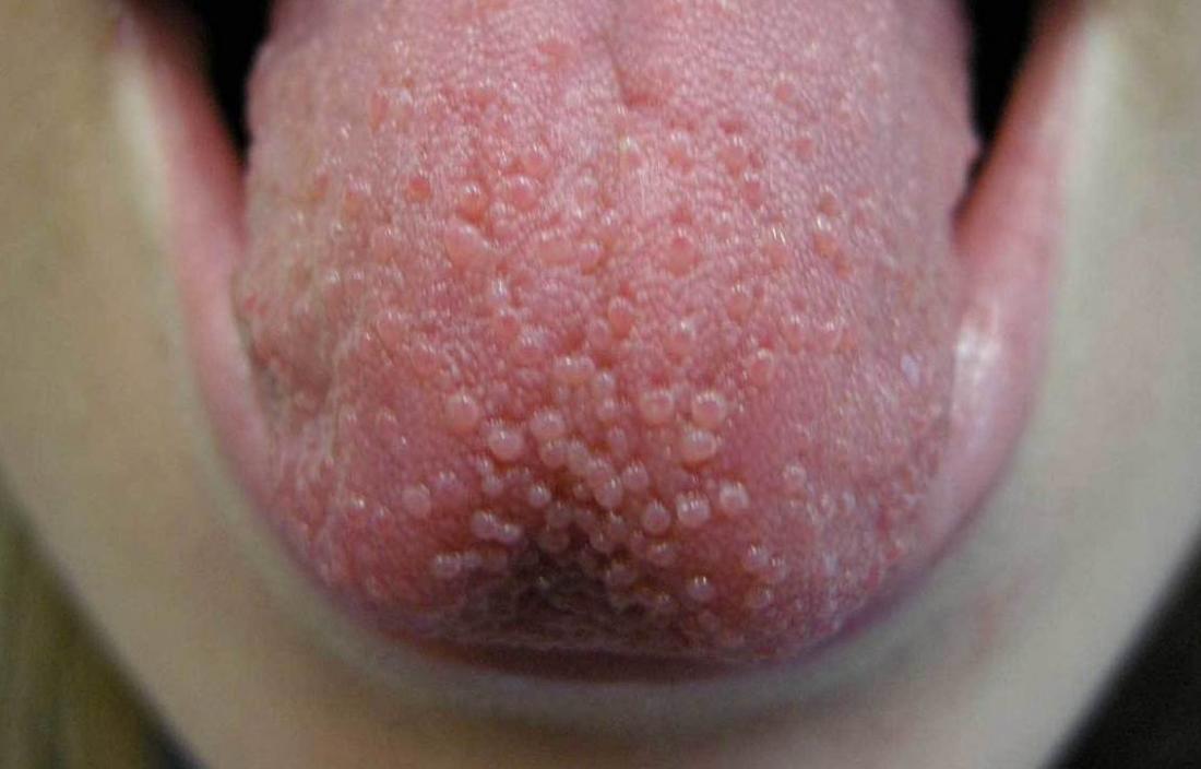 std tongue bumps