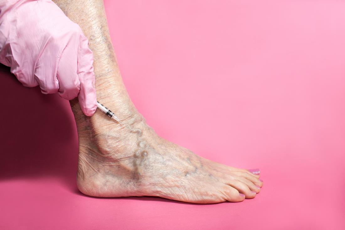 Sclerotherapy: Uses, side effects, and recovery