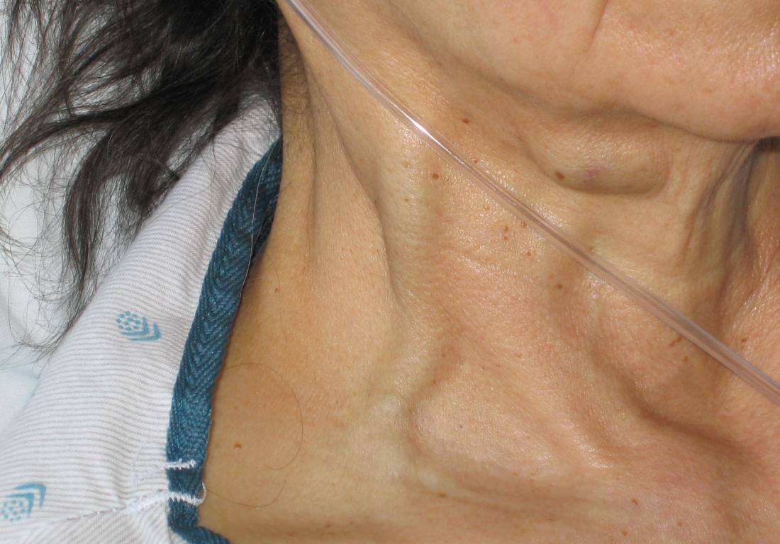 Jugular vein distention. Image credit: Ferencga, (2003, one 25)
