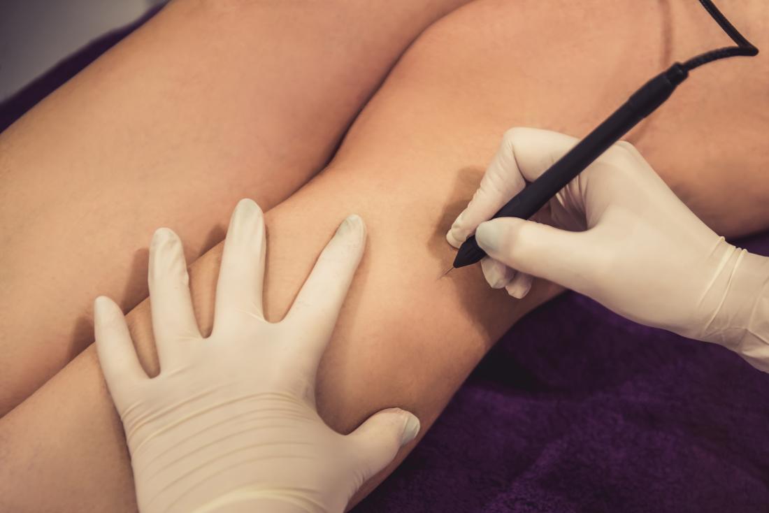 permanent hair removal electrolysis