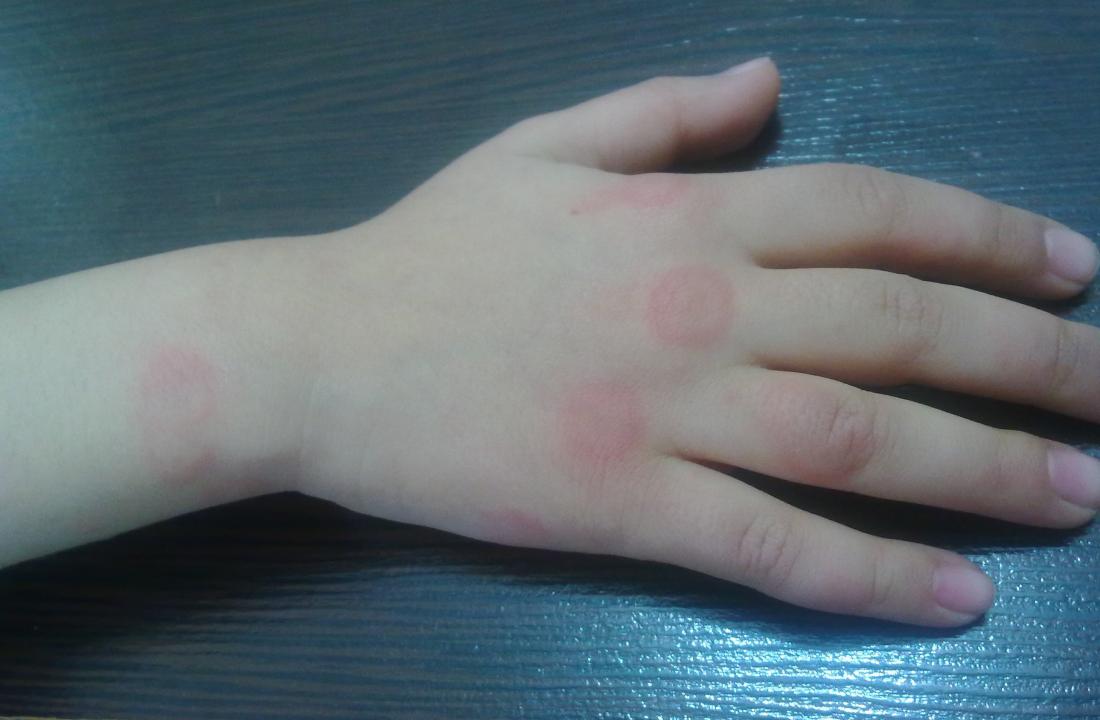 Papular urticaria. Image credit: Alborz Fallah, (2013, December 16)