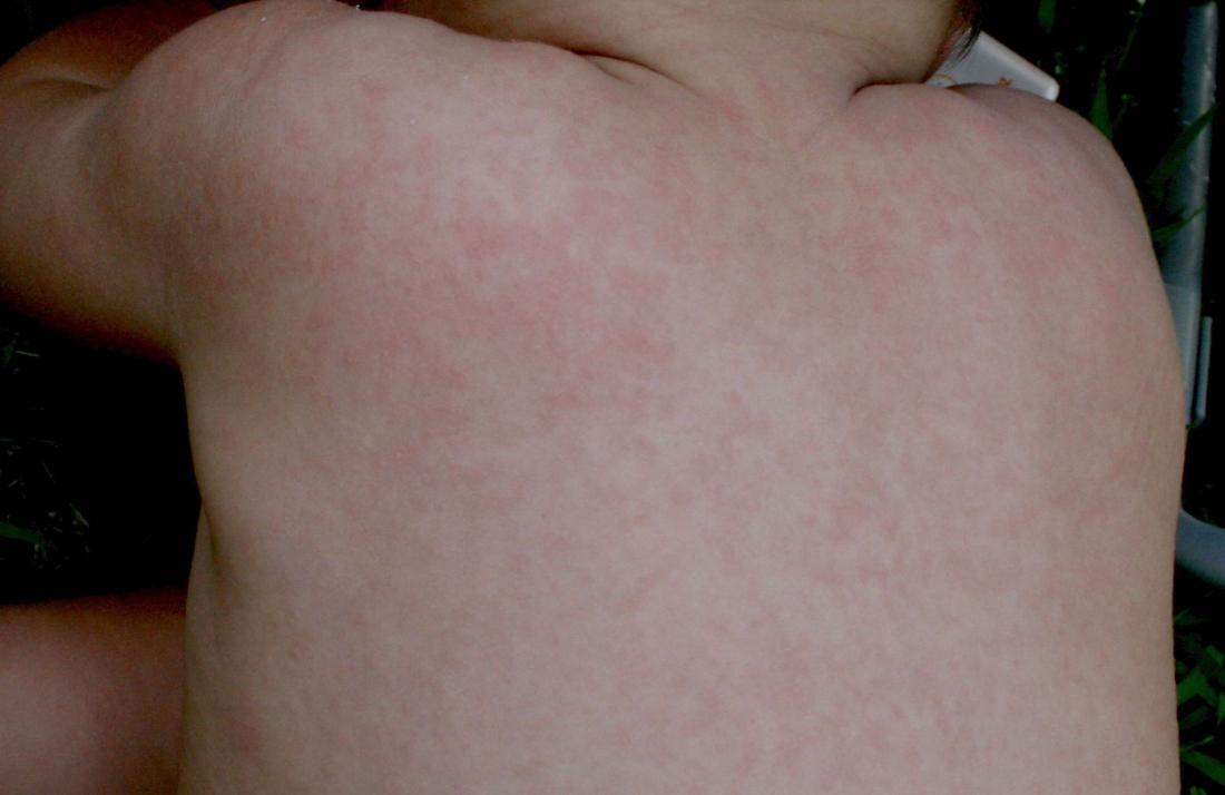 Roseola: Symptoms, causes, and treatment