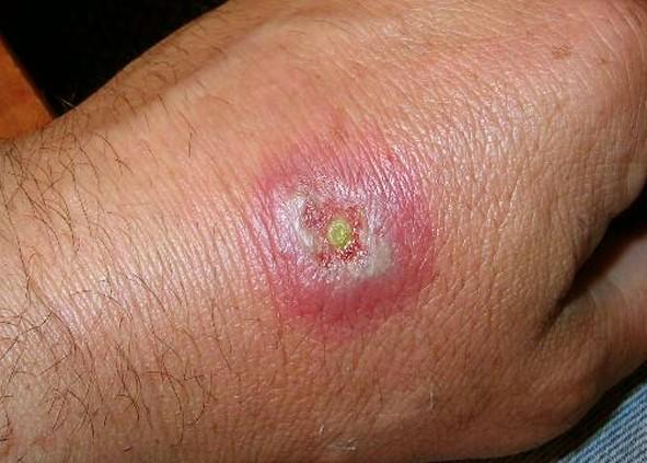 Hobo spider bite