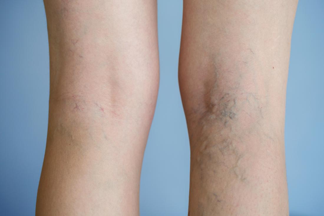 Varicose Vein Pain Symptoms And Treatment