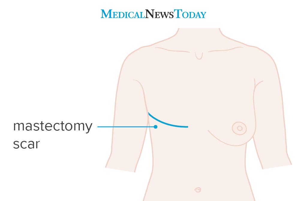 double mastectomy scars