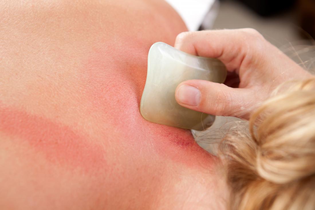 Have you guys heard of Gua Sha therapy? 1